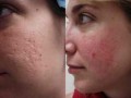 Acne Cure