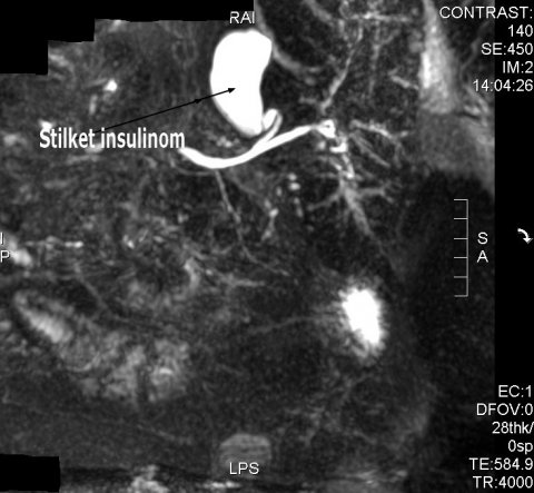 MR-scanningsbillede af stilket insulinom
