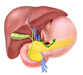 Enukleation insulinom pancreas