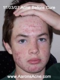 Acne Cure